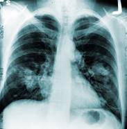 20111107-lung.jpg